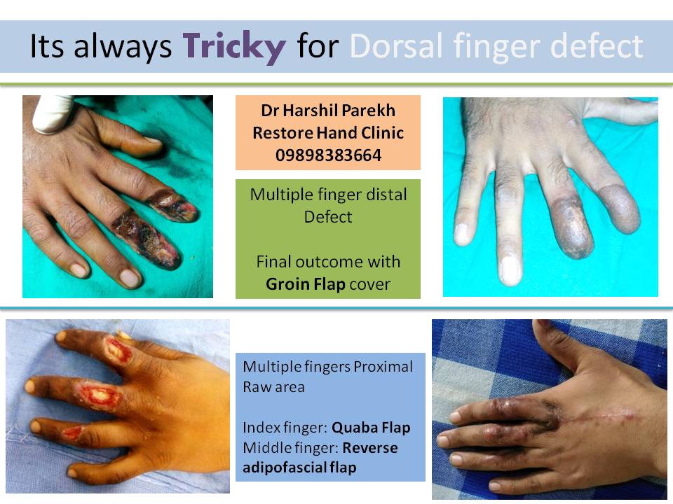 Dorsal finger flaps