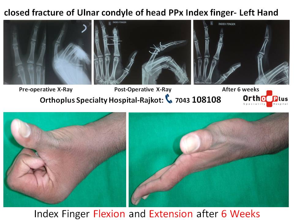 Finger joint micro fractures