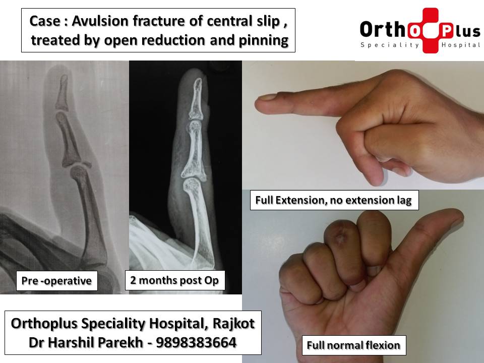 central tendon injury